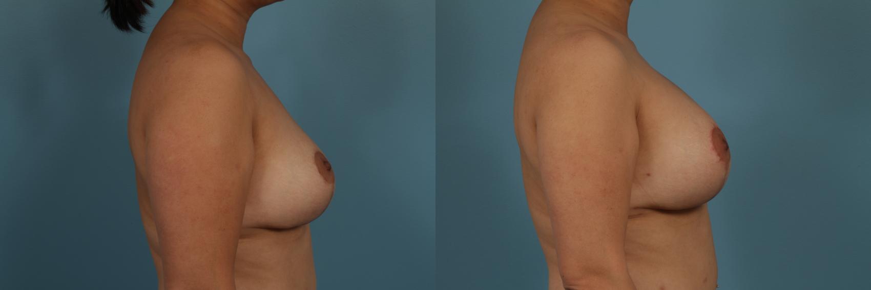 Before & After Breast Augmentation With Lift Case 312 View #3 View in Chicago, IL