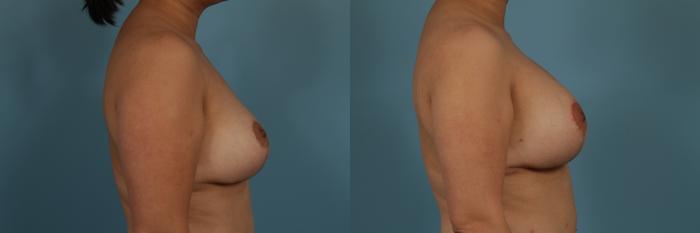 Before & After Breast Augmentation With Lift Case 312 View #3 View in Chicago, IL