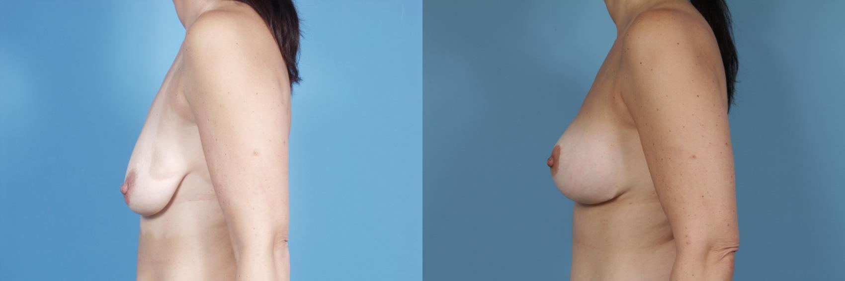 Before & After Breast Augmentation With Lift Case 360 View #2 View in Chicago, IL