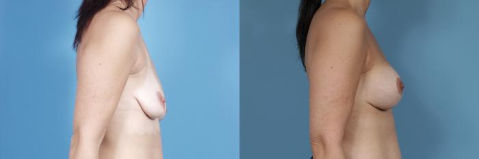 Before & After Breast Augmentation With Lift Case 360 View #3 View in Chicago, IL