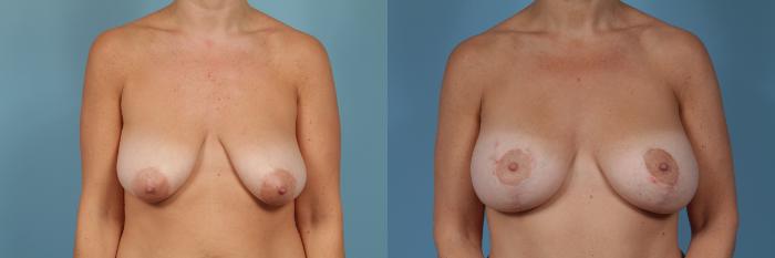 Before & After Breast Augmentation With Lift Case 363 View #1 View in Chicago, IL