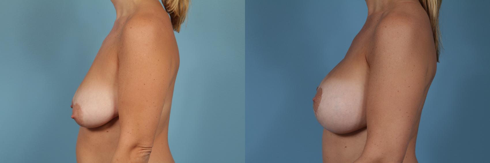 Before & After Breast Augmentation With Lift Case 363 View #2 View in Chicago, IL