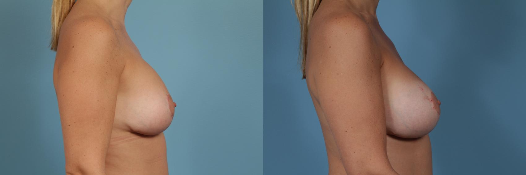 Before & After Breast Augmentation With Lift Case 363 View #3 View in Chicago, IL
