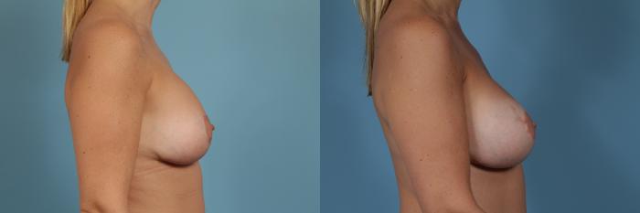 Before & After Breast Augmentation With Lift Case 363 View #3 View in Chicago, IL