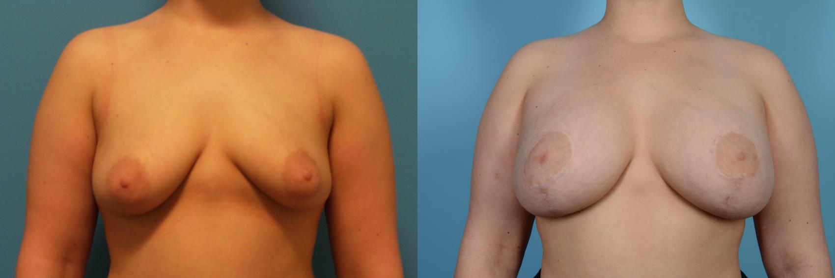 Before & After Breast Augmentation With Lift Case 449 View #1 View in Chicago, IL