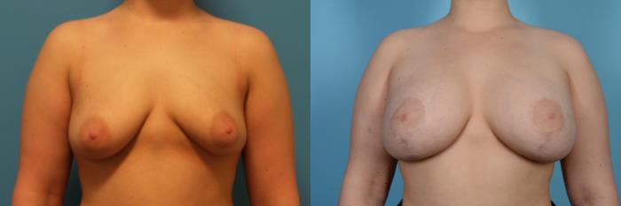 Before & After Breast Augmentation With Lift Case 449 View #1 View in Chicago, IL