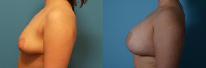 Before & After Breast Augmentation With Lift Case 449 View #2 View in Chicago, IL