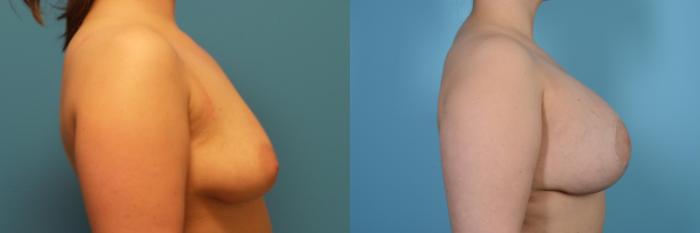 Before & After Breast Augmentation With Lift Case 449 View #3 View in Chicago, IL