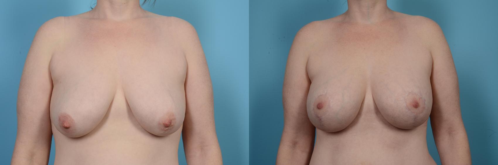 Before & After Breast Augmentation With Lift Case 503 View #1 View in Chicago, IL