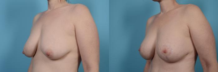 Before & After Breast Augmentation With Lift Case 503 View #2 View in Chicago, IL