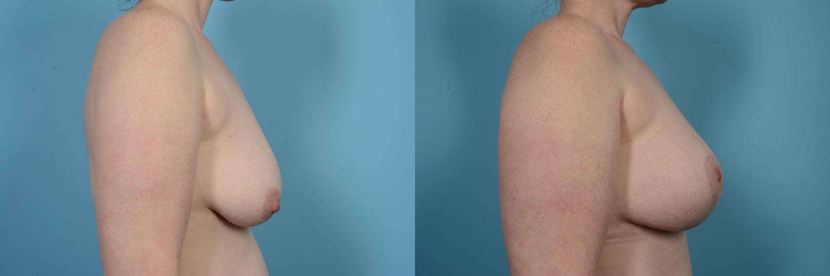 Before & After Breast Augmentation With Lift Case 503 View #3 View in Chicago, IL