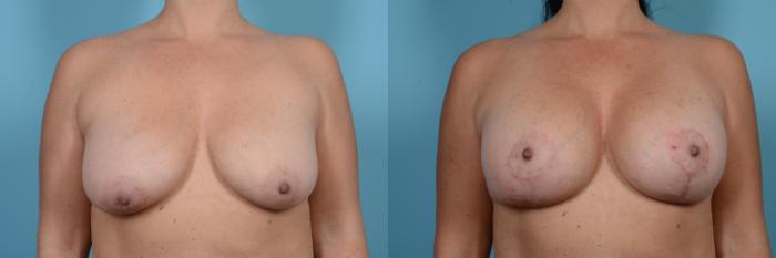 Before & After Breast Augmentation With Lift Case 521 View #1 View in Chicago, IL