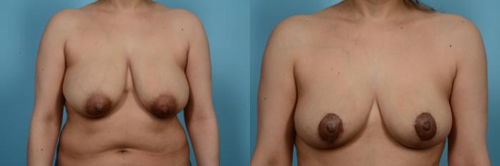 Before & After Breast Augmentation With Lift Case 546 View #1 View in Chicago, IL
