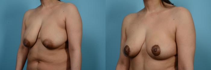 Before & After Breast Augmentation With Lift Case 546 View #2 View in Chicago, IL