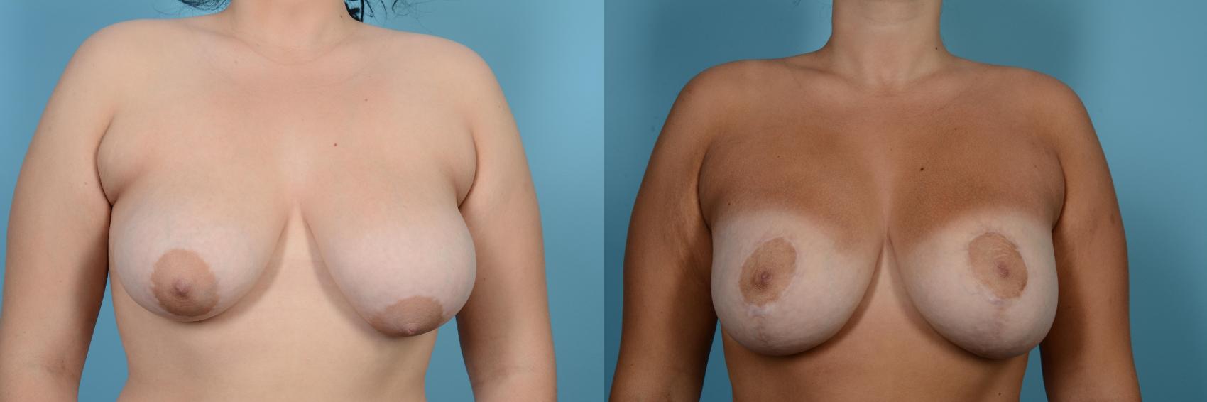 Before & After Breast Augmentation With Lift Case 554 View #1 View in Chicago, IL