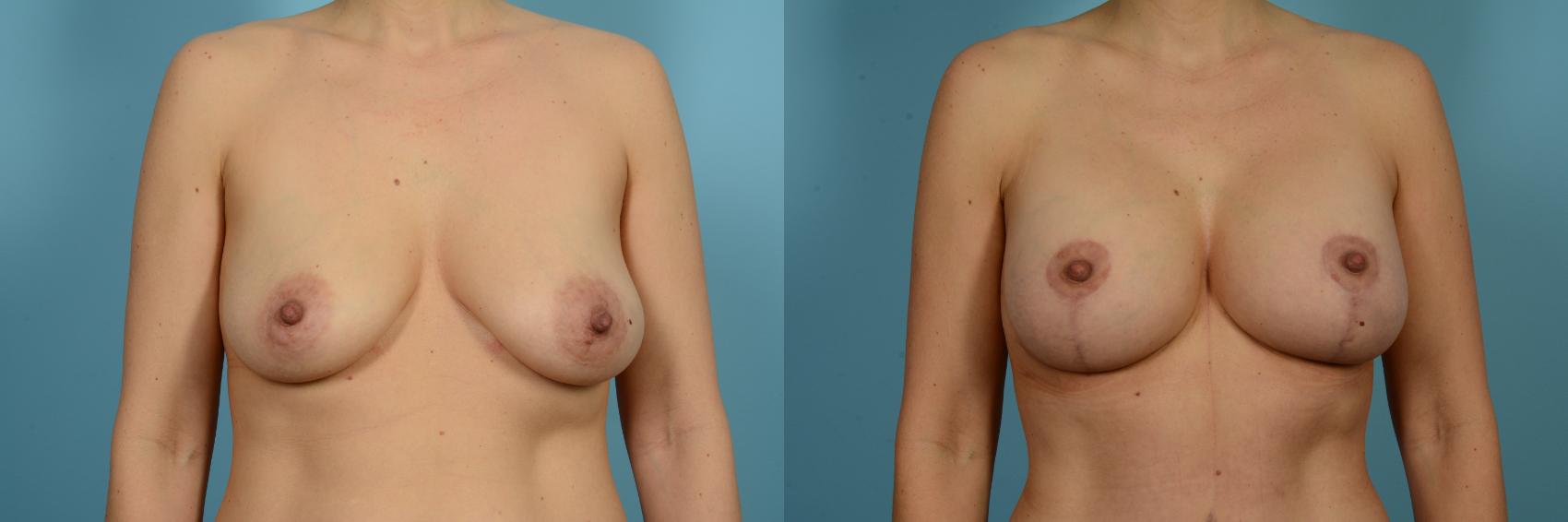 Dr. Sinno Breast Augmentation in Chicago, Illinois