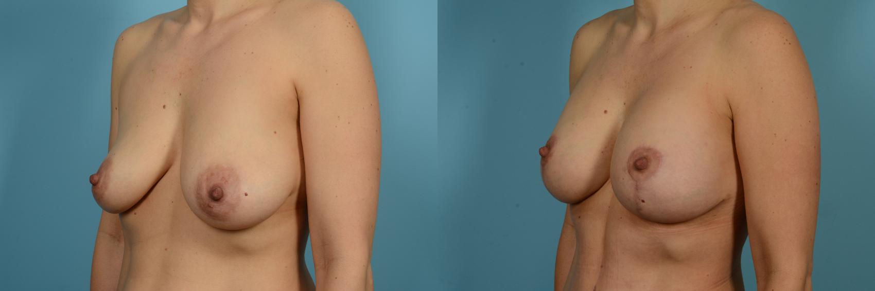 Dr. Sinno Breast Augmentation in Chicago, Illinois