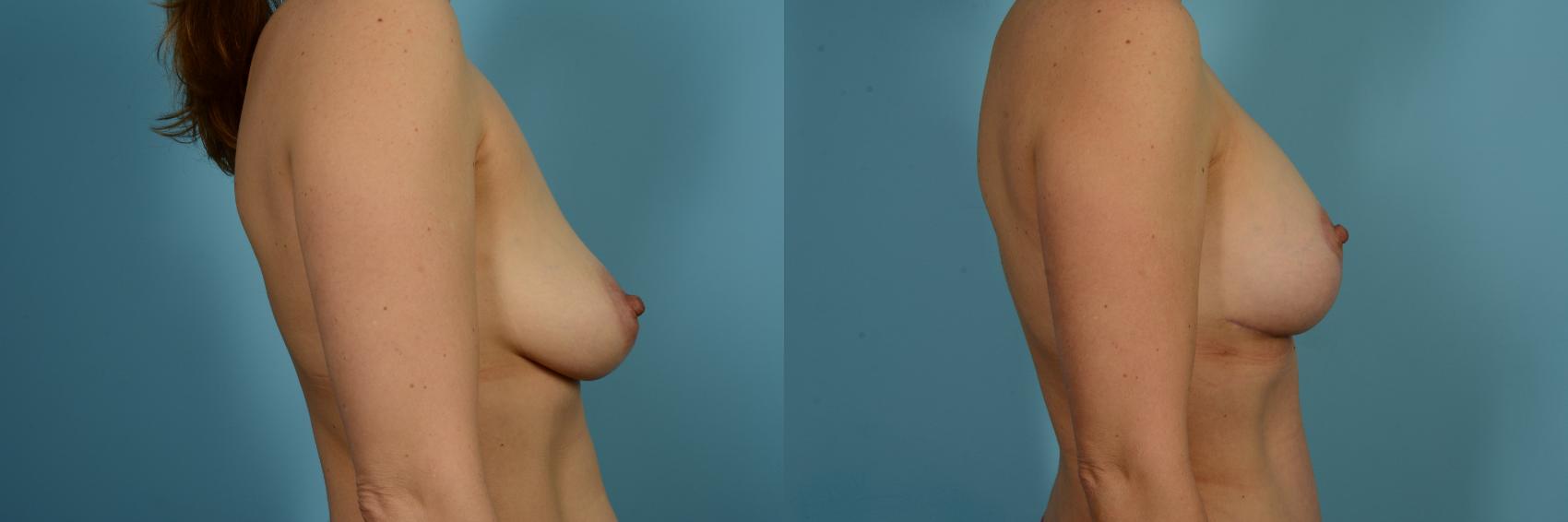 Dr. Sinno Breast Augmentation in Chicago, Illinois