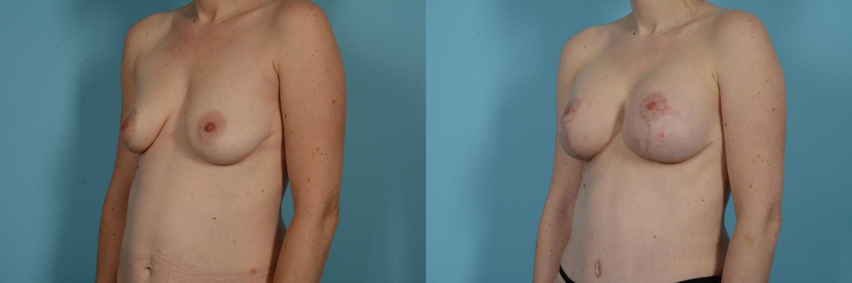 Dr. Sinno Mastopexy in Chicago, Illinois