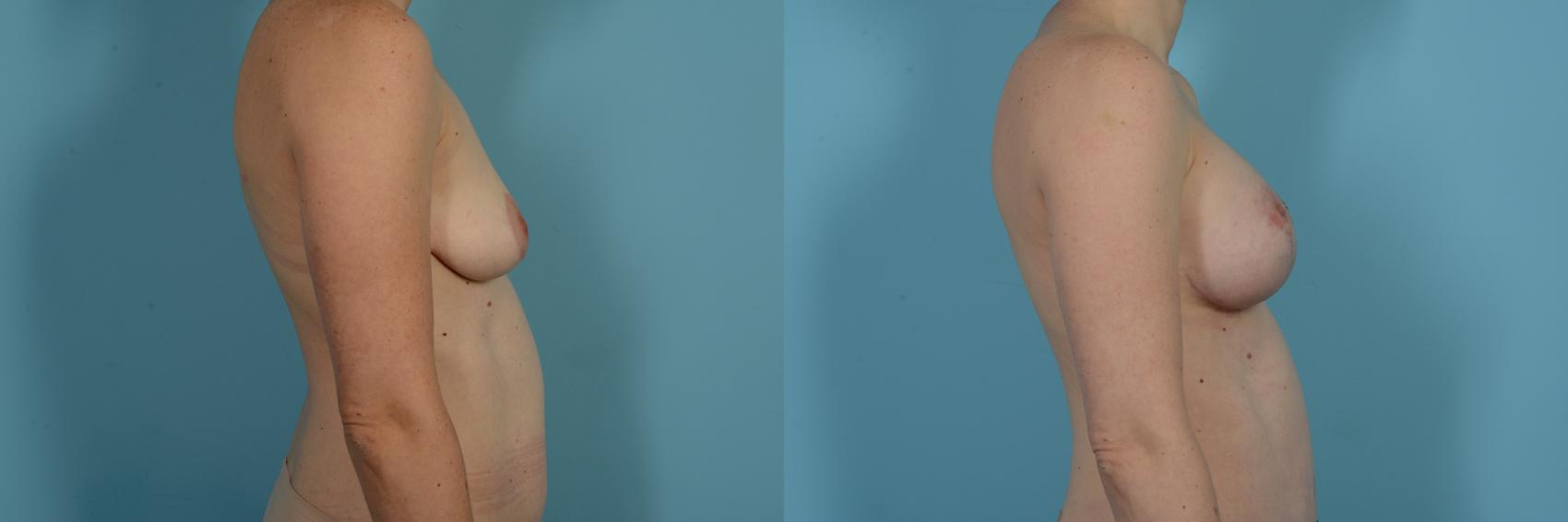 Dr. Sinno Mastopexy in Chicago, Illinois