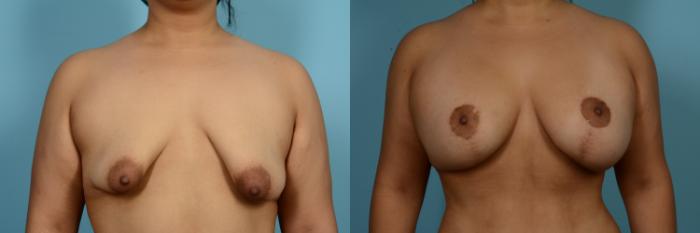 Before & After Breast Augmentation With Lift Case 767 Front View in Chicago, IL