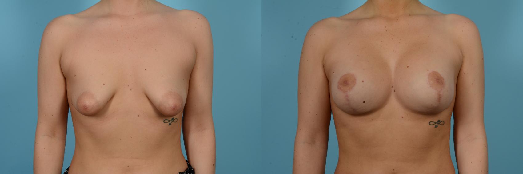 Before & After Breast Augmentation With Lift Case 804 Front View in Chicago, IL