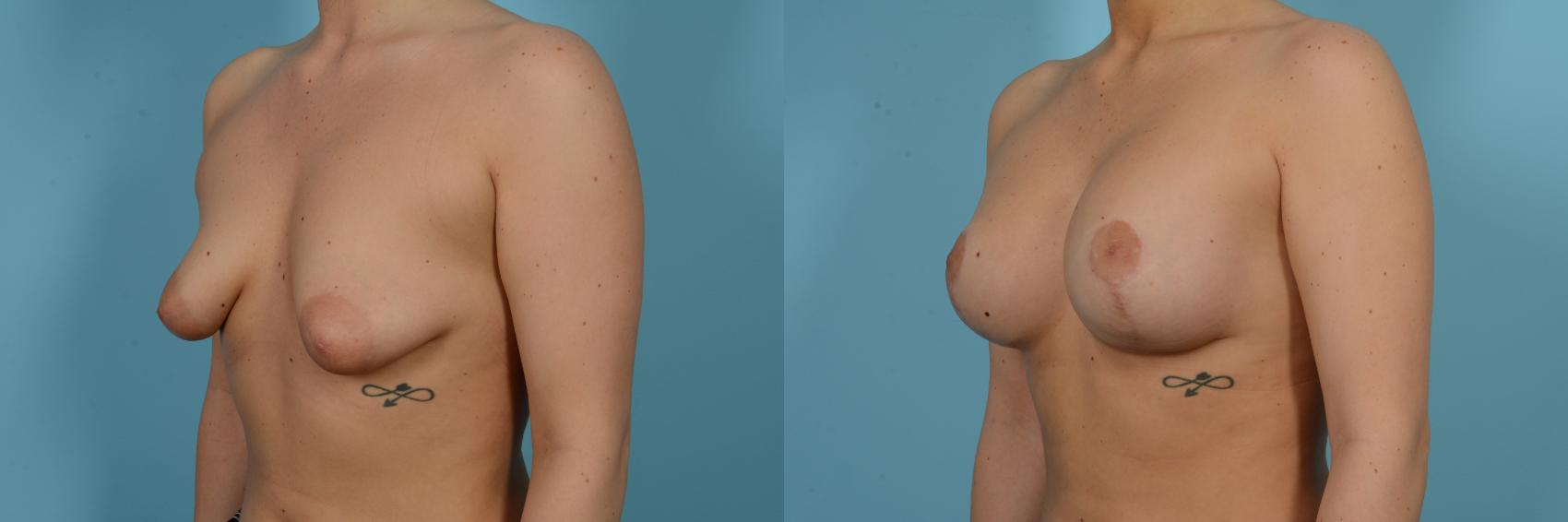 Before & After Breast Augmentation With Lift Case 804 Left Oblique View in Chicago, IL