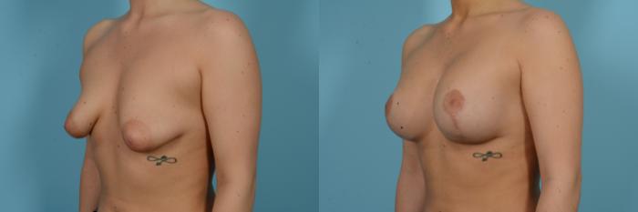 Before & After Breast Augmentation With Lift Case 804 Left Oblique View in Chicago, IL