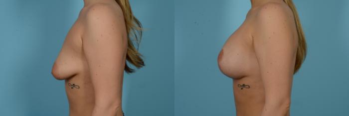 Before & After Breast Augmentation With Lift Case 804 Left Side View in Chicago, IL