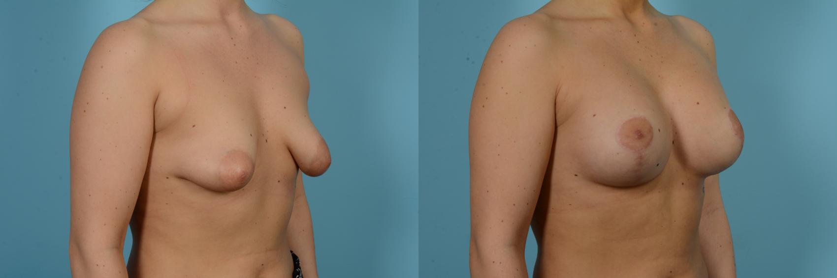 Before & After Breast Augmentation With Lift Case 804 Right Oblique View in Chicago, IL