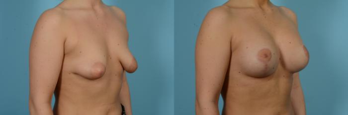 Before & After Breast Augmentation With Lift Case 804 Right Oblique View in Chicago, IL