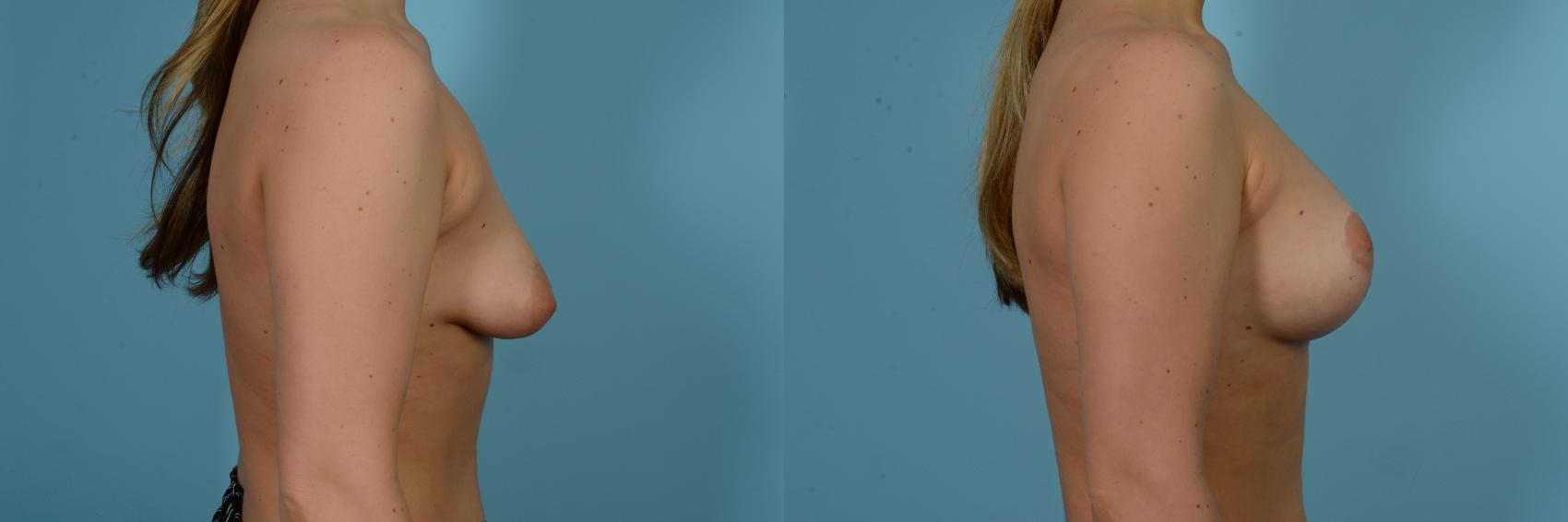 Before & After Breast Augmentation With Lift Case 804 Right Side View in Chicago, IL