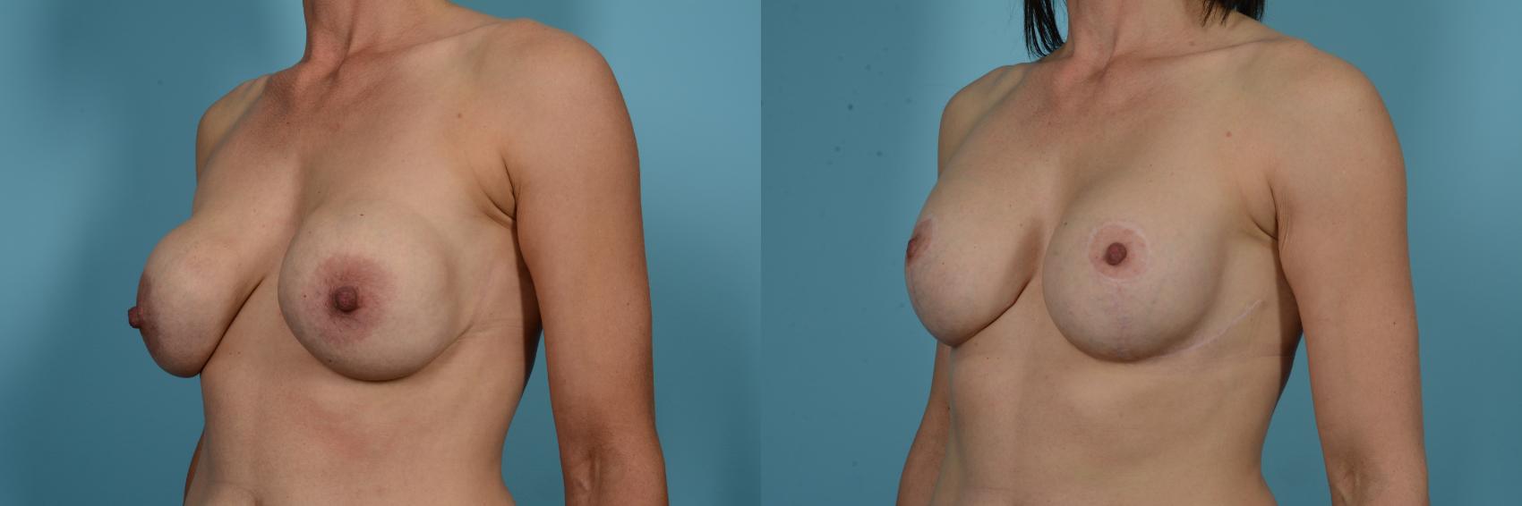 Before & After Breast Augmentation With Lift Case 812 Left Oblique View in Chicago, IL