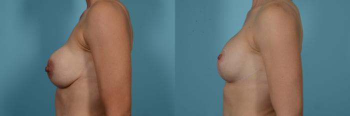 Before & After Breast Augmentation With Lift Case 812 Left Side View in Chicago, IL