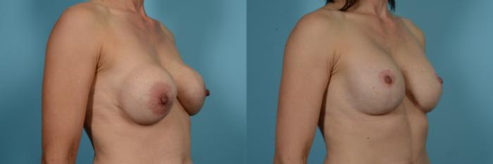 Before & After Breast Augmentation With Lift Case 812 Right Oblique View in Chicago, IL