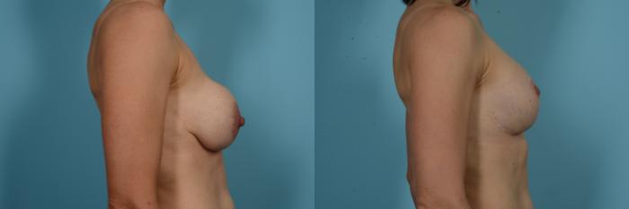 Before & After Breast Implant Replacement Case 812 Right Side View in Chicago, IL