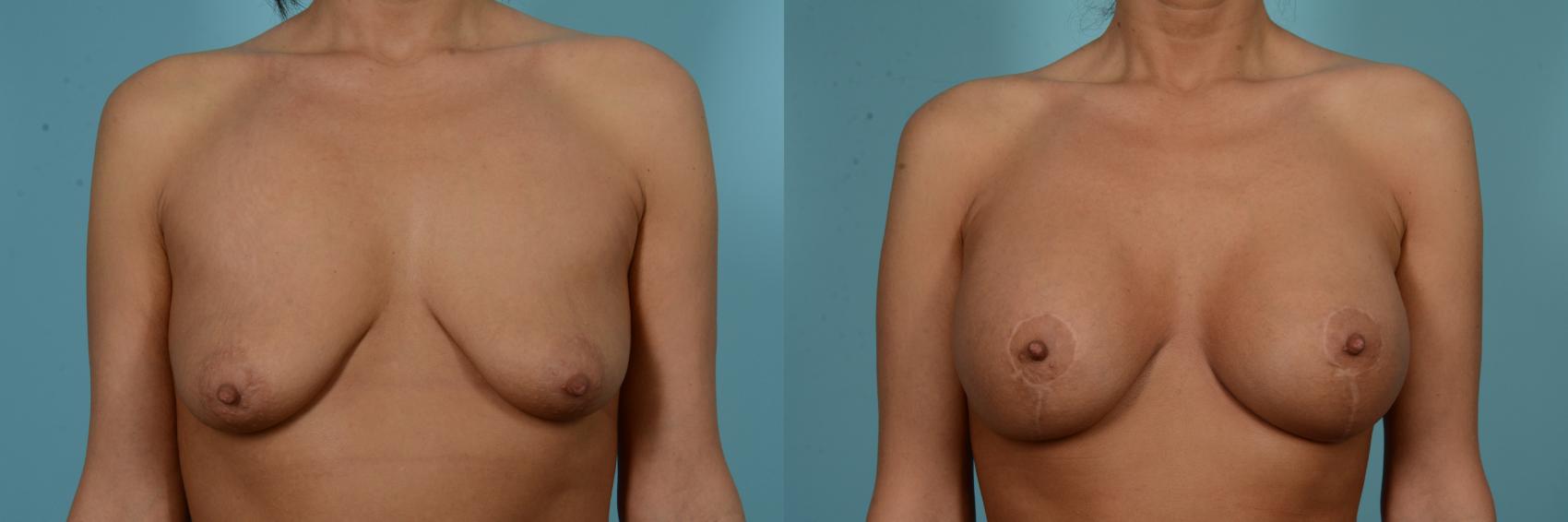 Before & After Breast Lift Case 874 Front View in Chicago, IL