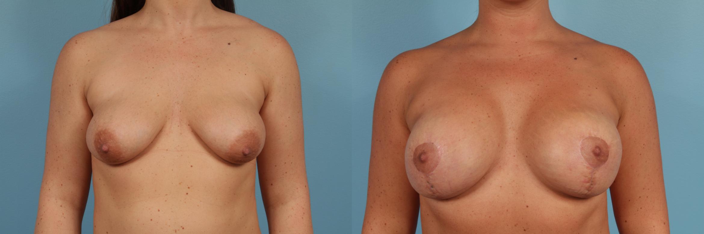 Before & After Breast Augmentation With Lift Case 179 View #1 View in Chicago, IL