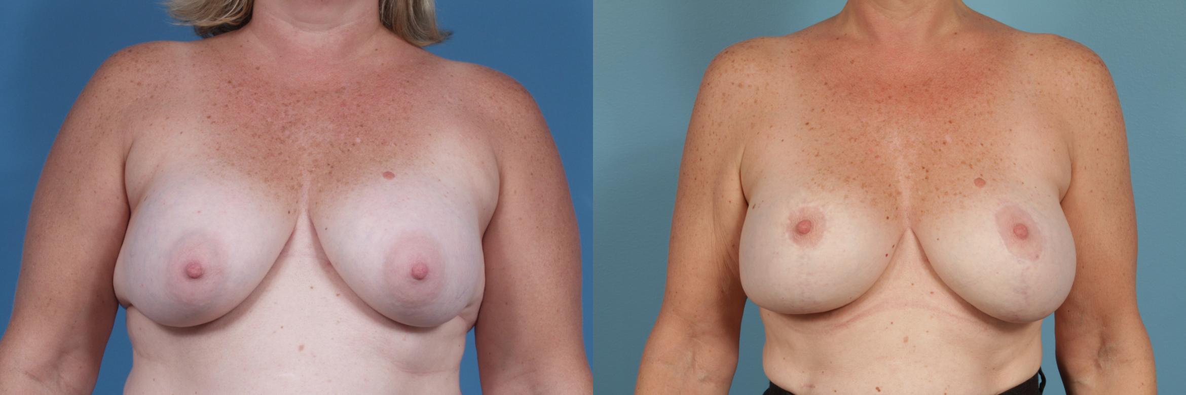 Before & After Breast Augmentation With Lift Case 195 View #1 View in Chicago, IL