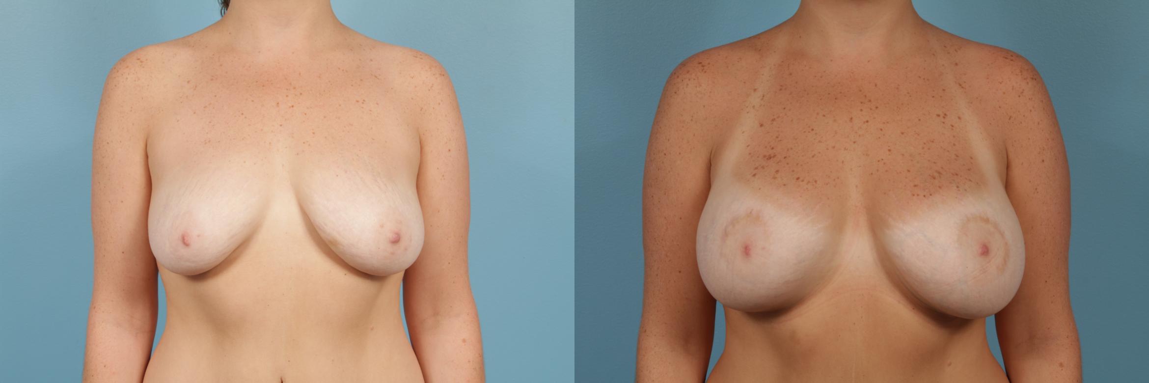Before & After Breast Augmentation With Lift Case 252 View #1 View in Chicago, IL