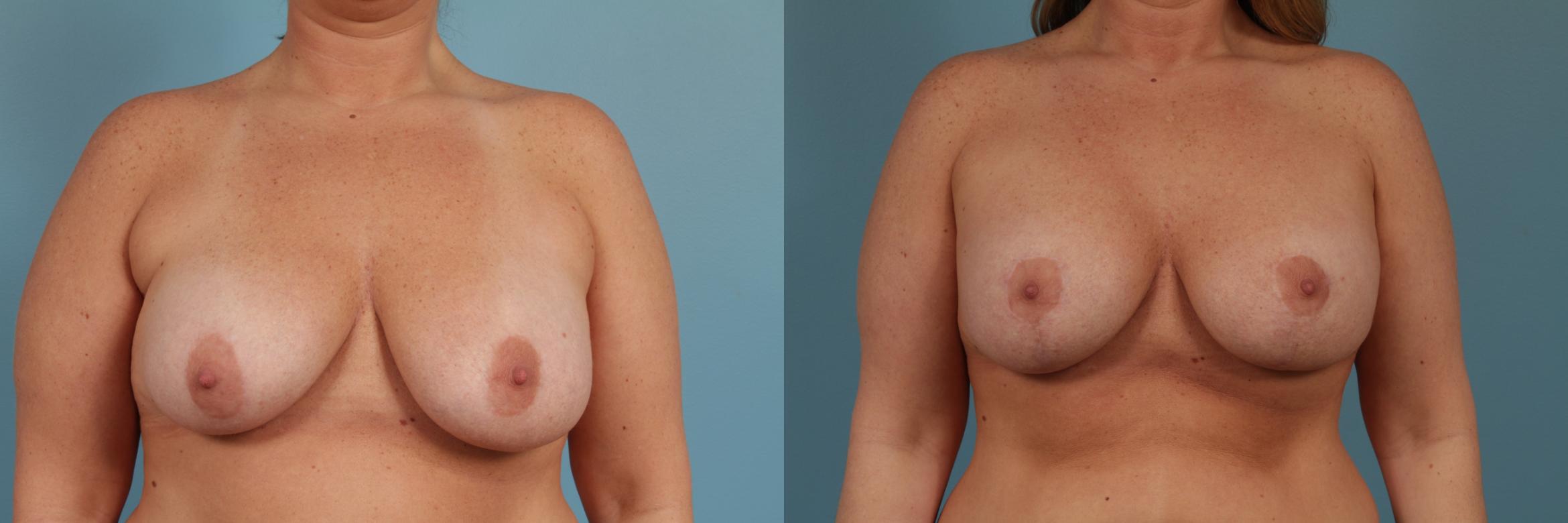 Before & After Breast Augmentation With Lift Case 288 View #1 View in Chicago, IL
