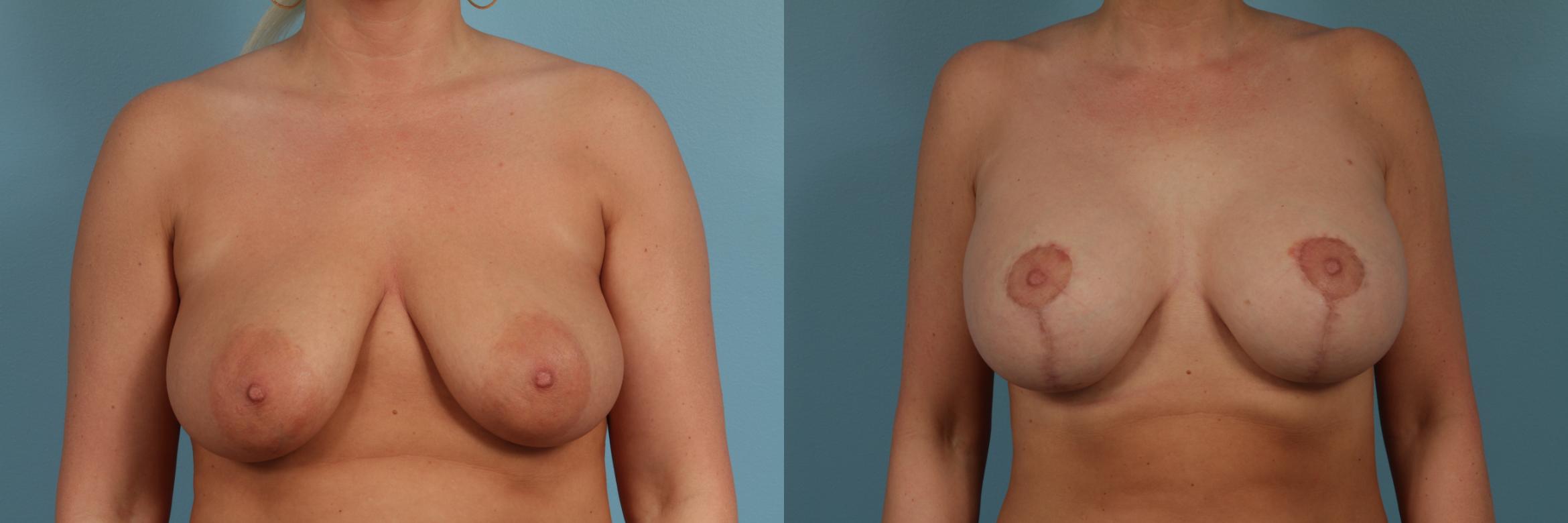 Before & After Breast Augmentation With Lift Case 306 View #1 View in Chicago, IL