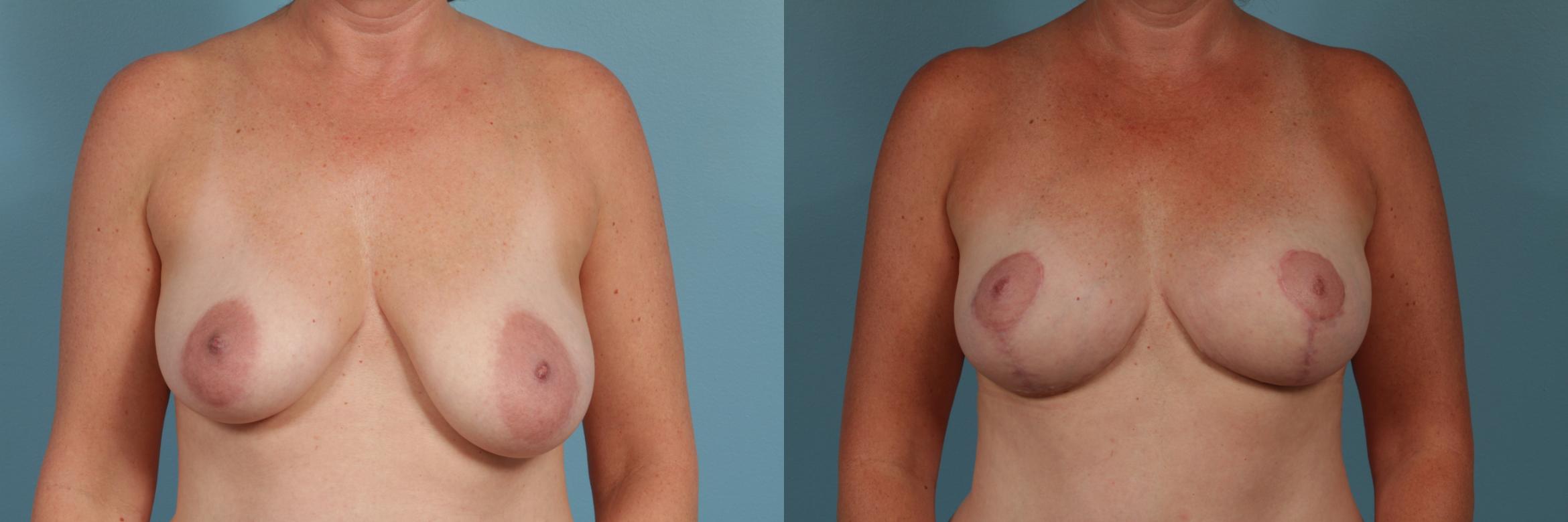 Before & After Breast Augmentation With Lift Case 307 View #1 View in Chicago, IL