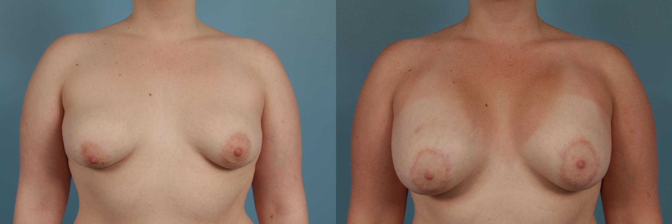 Before & After Breast Augmentation With Lift Case 308 View #1 View in Chicago, IL