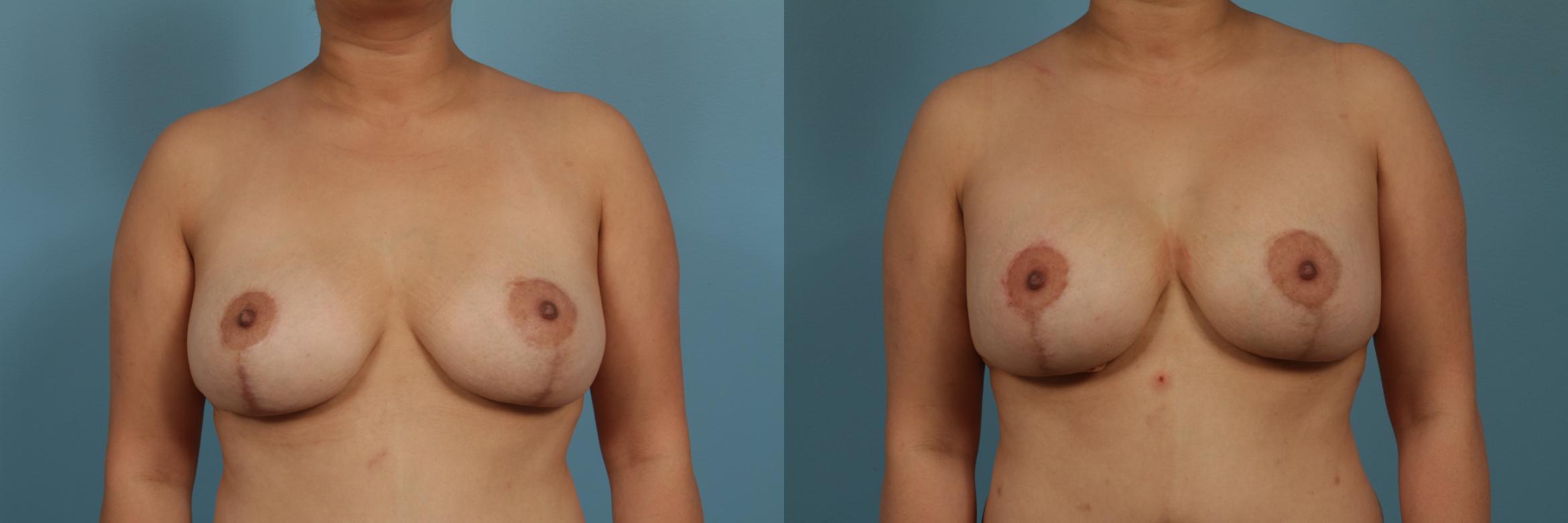 Before & After Breast Augmentation With Lift Case 312 View #1 View in Chicago, IL