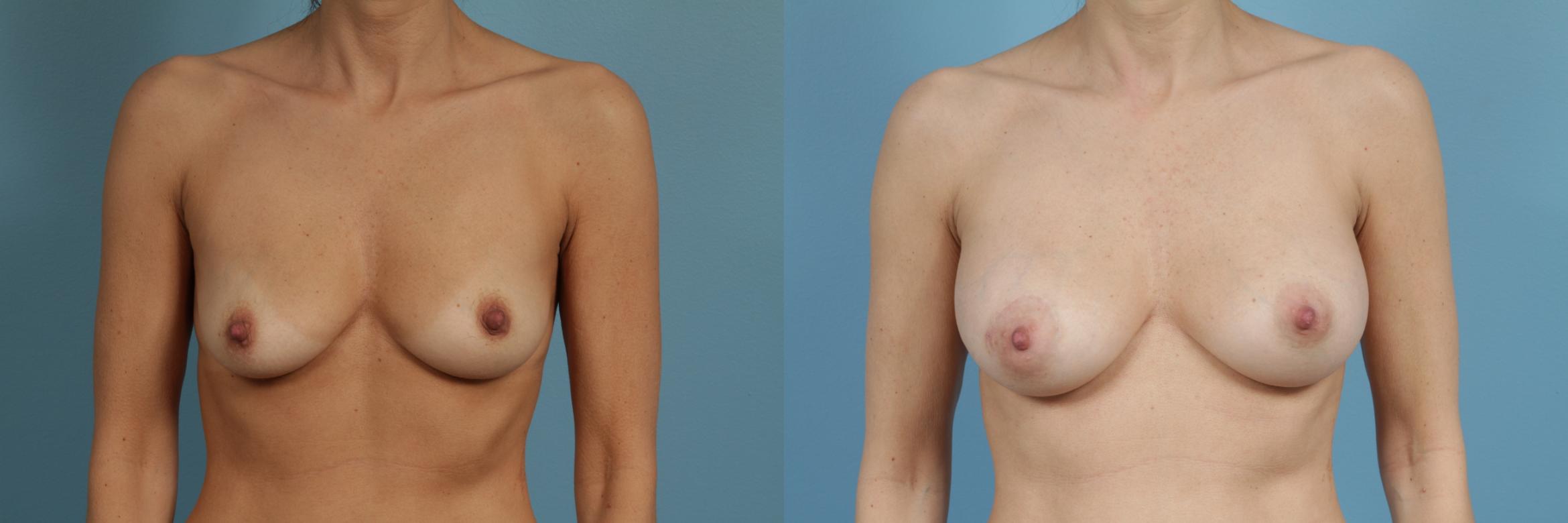 Before & After Breast Augmentation With Lift Case 346 View #1 View in Chicago, IL