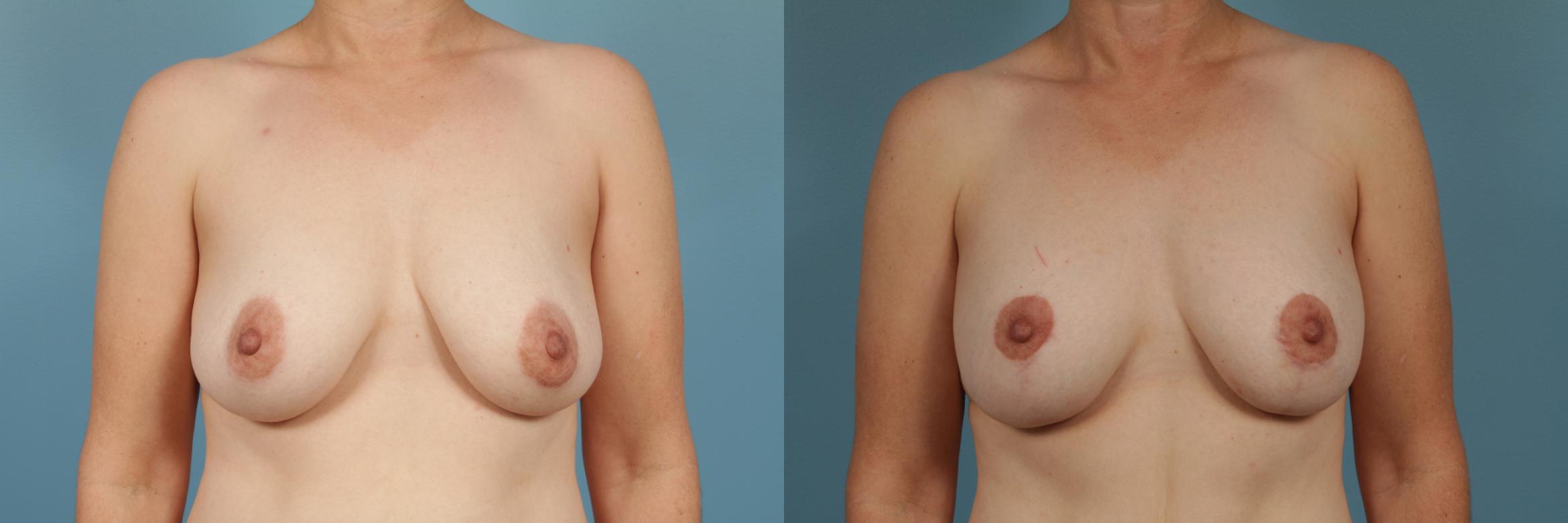 Before & After Breast Augmentation With Lift Case 361 View #1 View in Chicago, IL