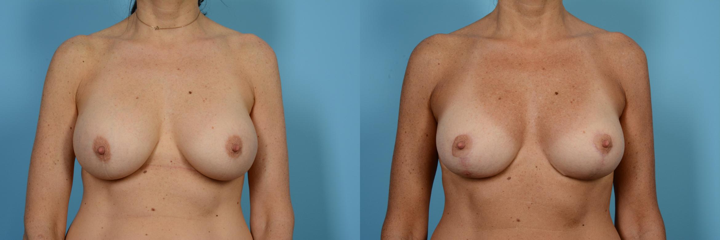 Before & After Breast Augmentation With Lift Case 476 View #1 View in Chicago, IL