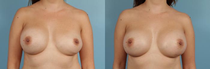 Before & After Breast Implant Replacement Case 163 View #1 View in Chicago, IL