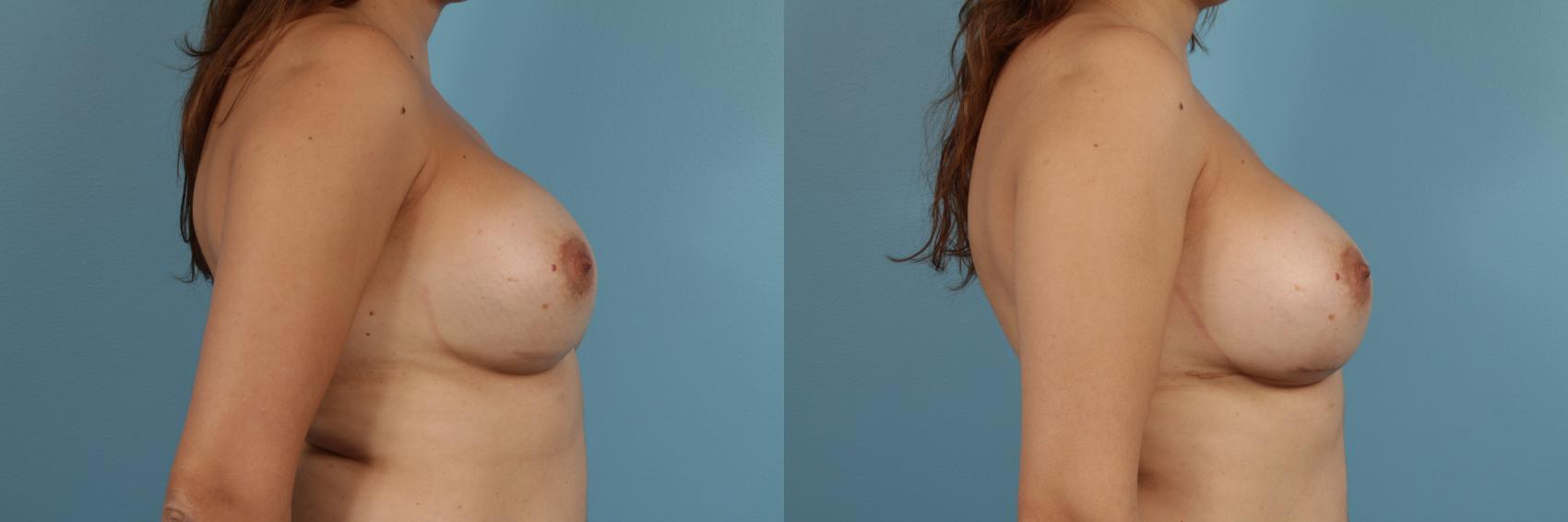 Before & After Breast Implant Replacement Case 163 View #3 View in Chicago, IL